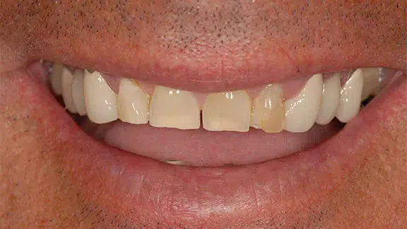 patient-case2-before.webp