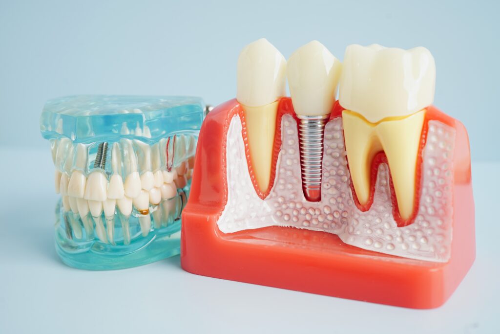 dental implant restoration Dunedin
