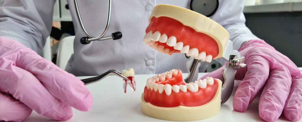 tooth extractions Dunedin