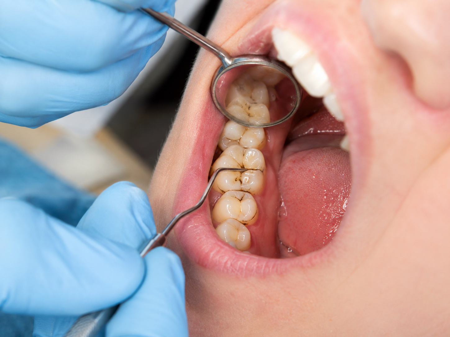 Close-up dental examination of molars with deep grooves and areas at higher risk for cavities