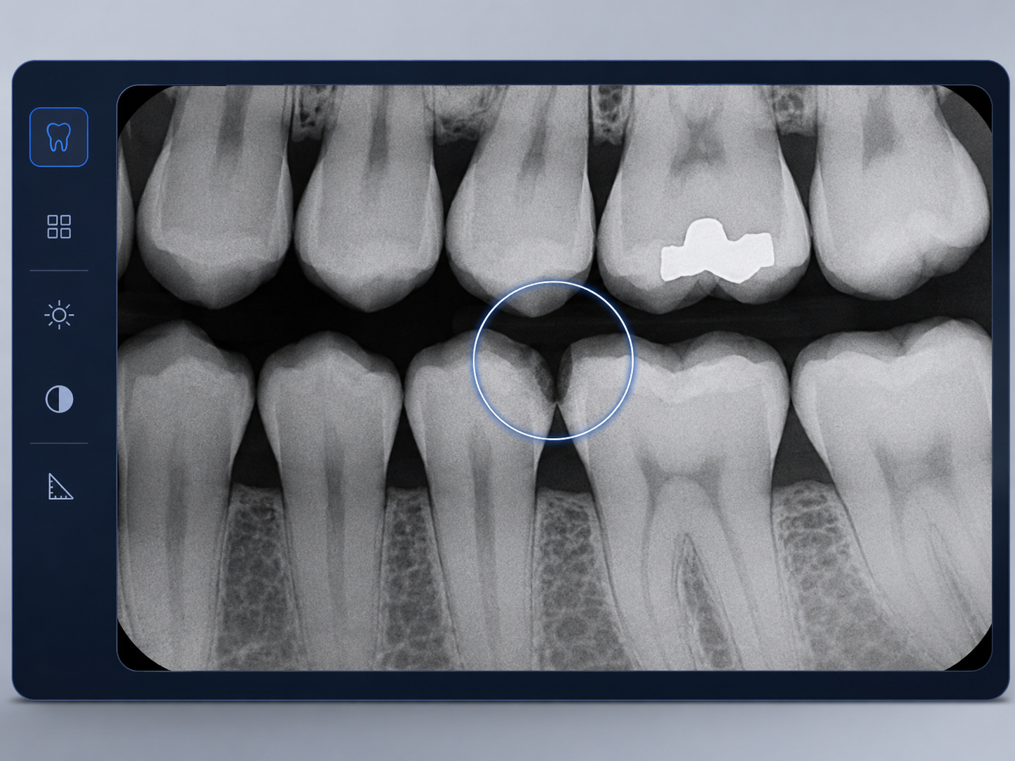 Bitewing digital dental X-ray showing possible decay between neighboring teeth