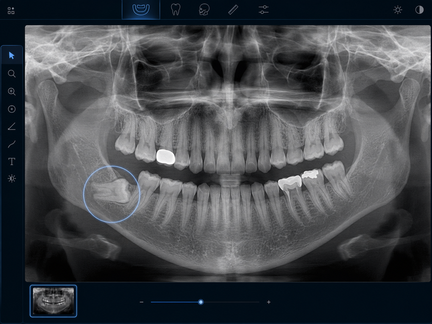 Panoramic dental X-ray showing an impacted tooth beneath the gumline