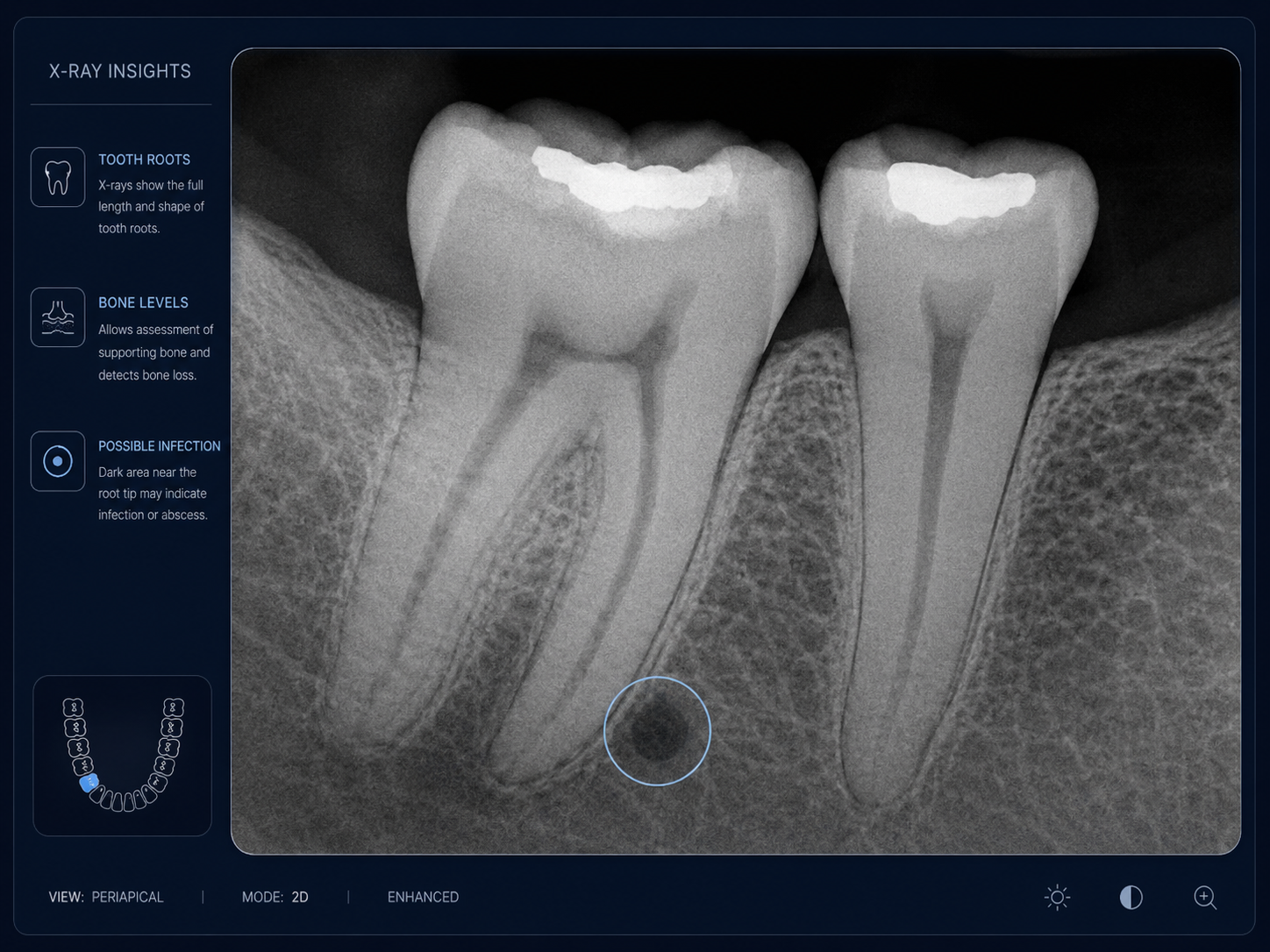 Periapical dental X-ray showing tooth roots, supporting bone levels, and a possible root-area infection